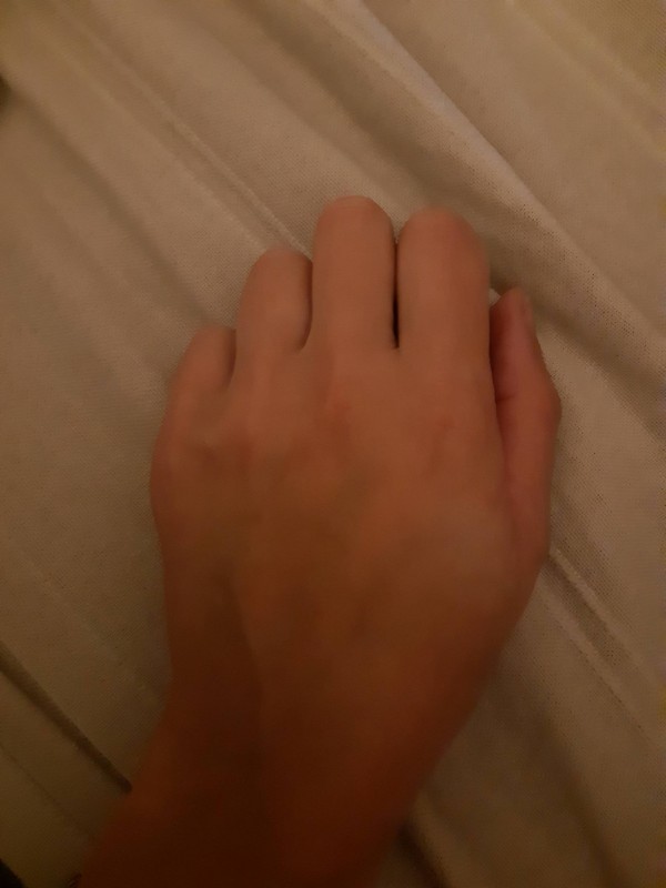 Mains abîmées à cause du gel hydroalcoolique à Bordeaux