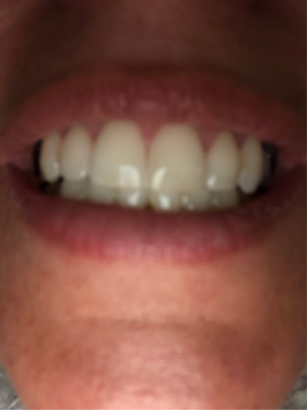 Recherche spécialiste du blanchiment des dents pas cher à Bordeaux